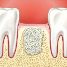 Наращивание костной ткани при имплантации