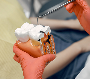 Лечение кариеса по выгодной цене 3950 руб!