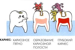 Стадии развития кариеса